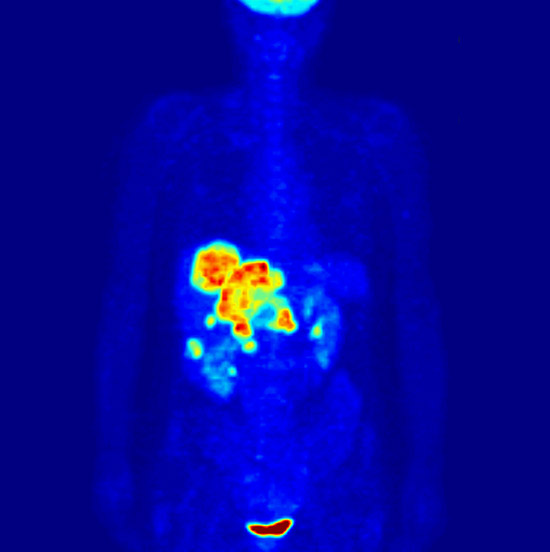 PET scan